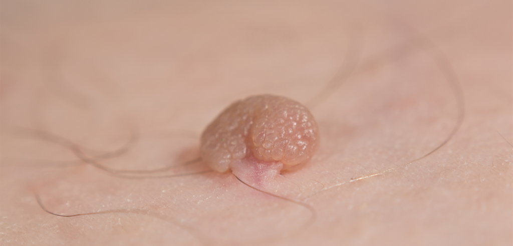 Warze mit Haaren auf einer Hautfläche