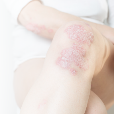 Knie mit Neurodermitis