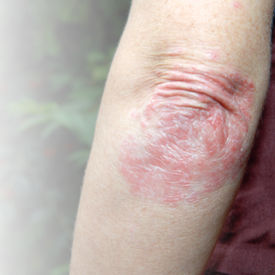 Ellbogen mit Neurodermitis