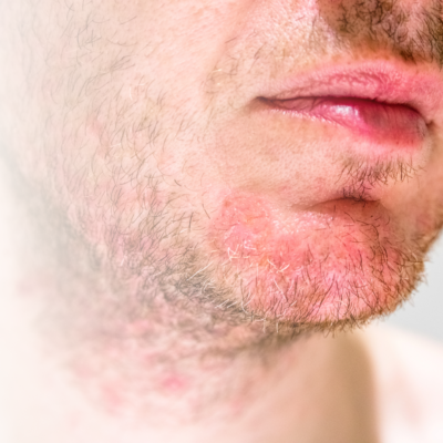 Kinnpartie eines Mannes mit Hautrötung