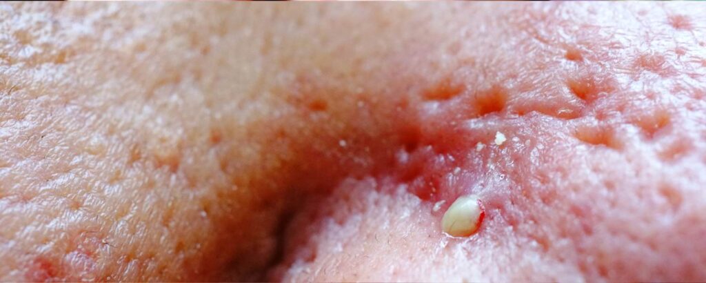 Eitriger Pickel auf vernarbter Haut