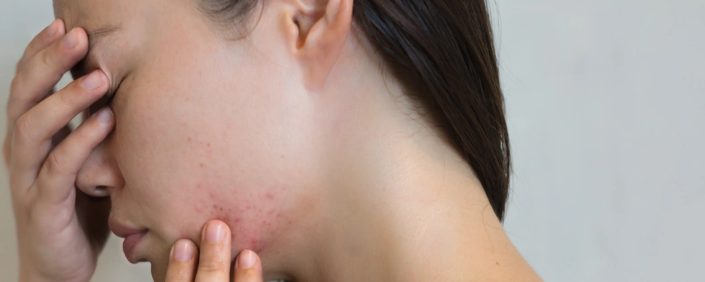 Frau hat Stressauschlag im Gesicht