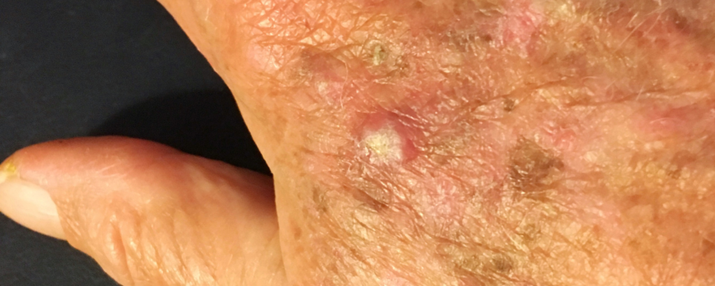 schuppiger Hautfleck Handrücken aktinische Keratose