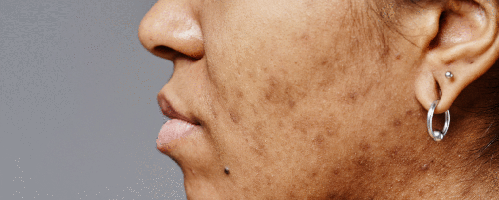 Postinflammatorische Hyperpigmentierung (PIH) im Gesicht