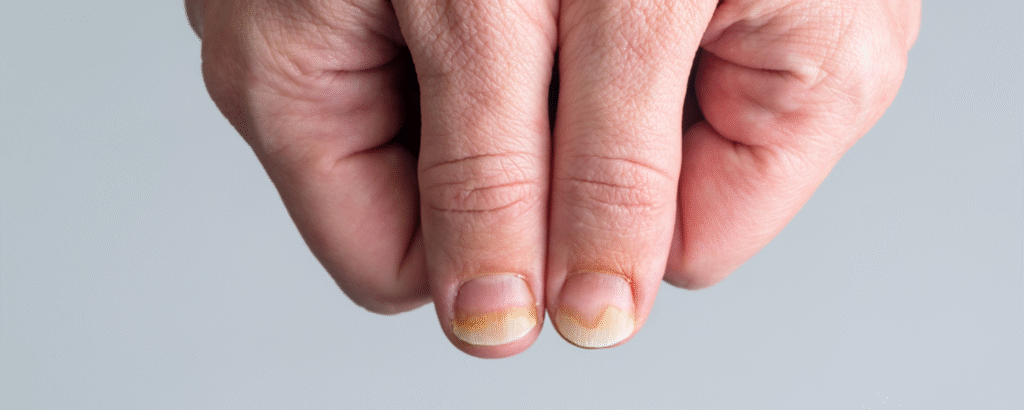 Veränderungen an beiden Daumennägeln, Nageldystrophie