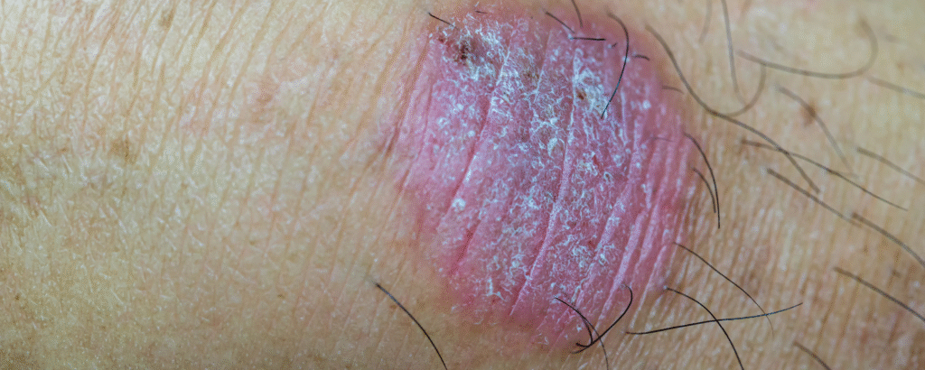 Tinea capitis und barbae Pilzinfektion Haut