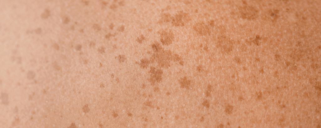 Melanin-Hyperpigmentierung, braune Flecken Verfärbung der Haut