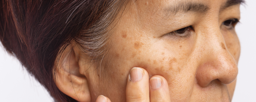Hyperpigmentierung im Gesicht einer Frau