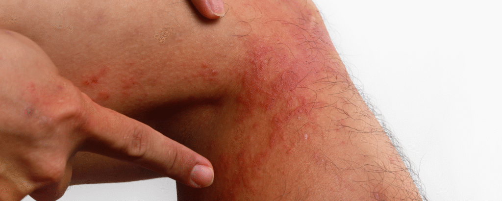 Lichen simplex chronicus Lichenifikation am Bein