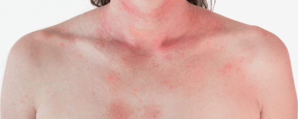 rote Stressflecken / Ausschlag an Hals und Dekolleté-Bereich