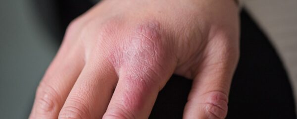 Hand mit Rötungen / Frostbeulen