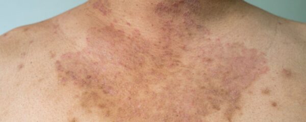 Dunkle Hautflecken am Hals und Brustansatz