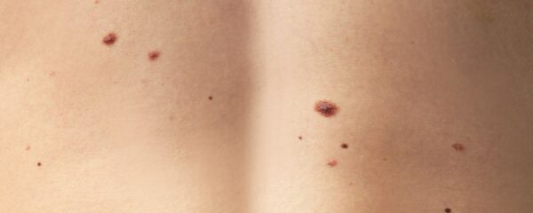 Muttermale auf der Haut