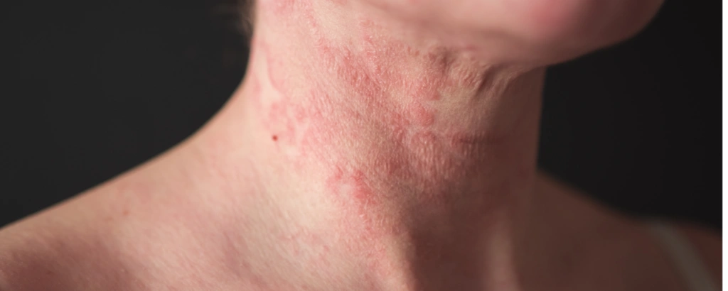 Dermatitis am Hals
