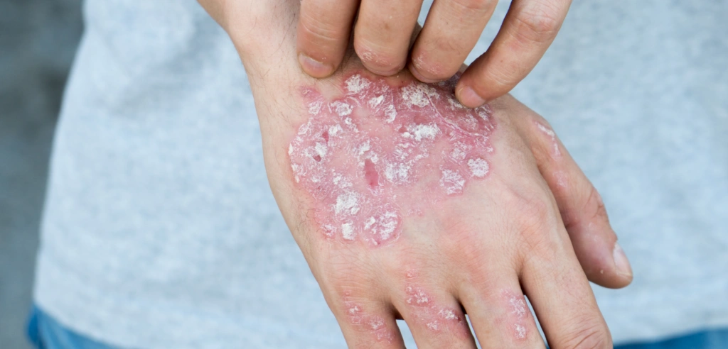 Neurodermitis an der Hand