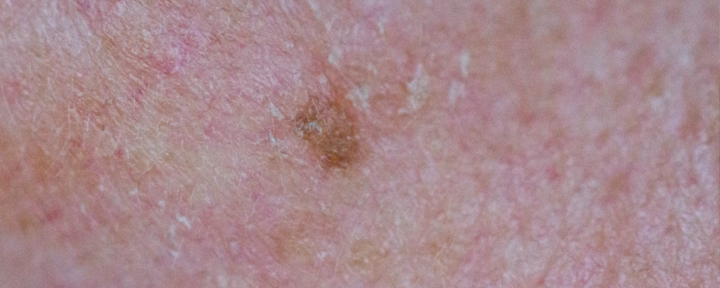 Aktinische Keratose