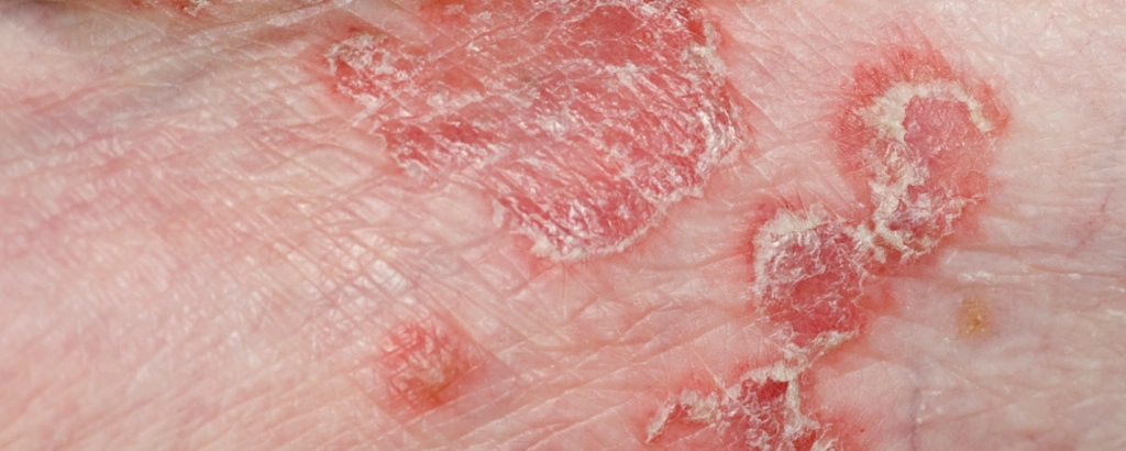 Knötchenflechte auf der Haut