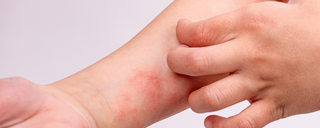 Lichen Simplex am Arm